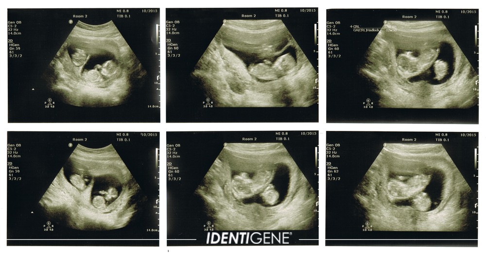IDENTIGENE: Twins with different fathers
